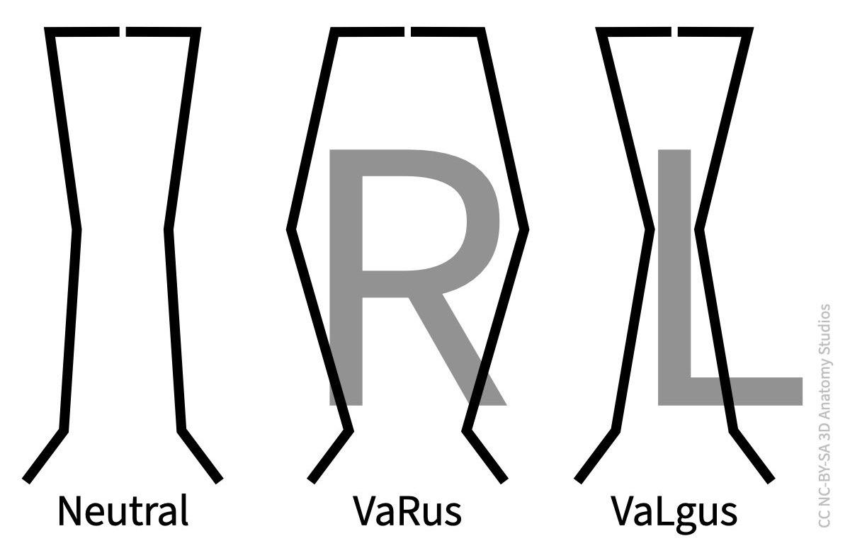 4 Knee simple illustration how to remember varus vs valgus.jpeg