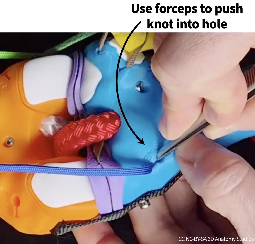 Photo of forceps pushing a manual muscle cord knot into an attachment hole on a bone
