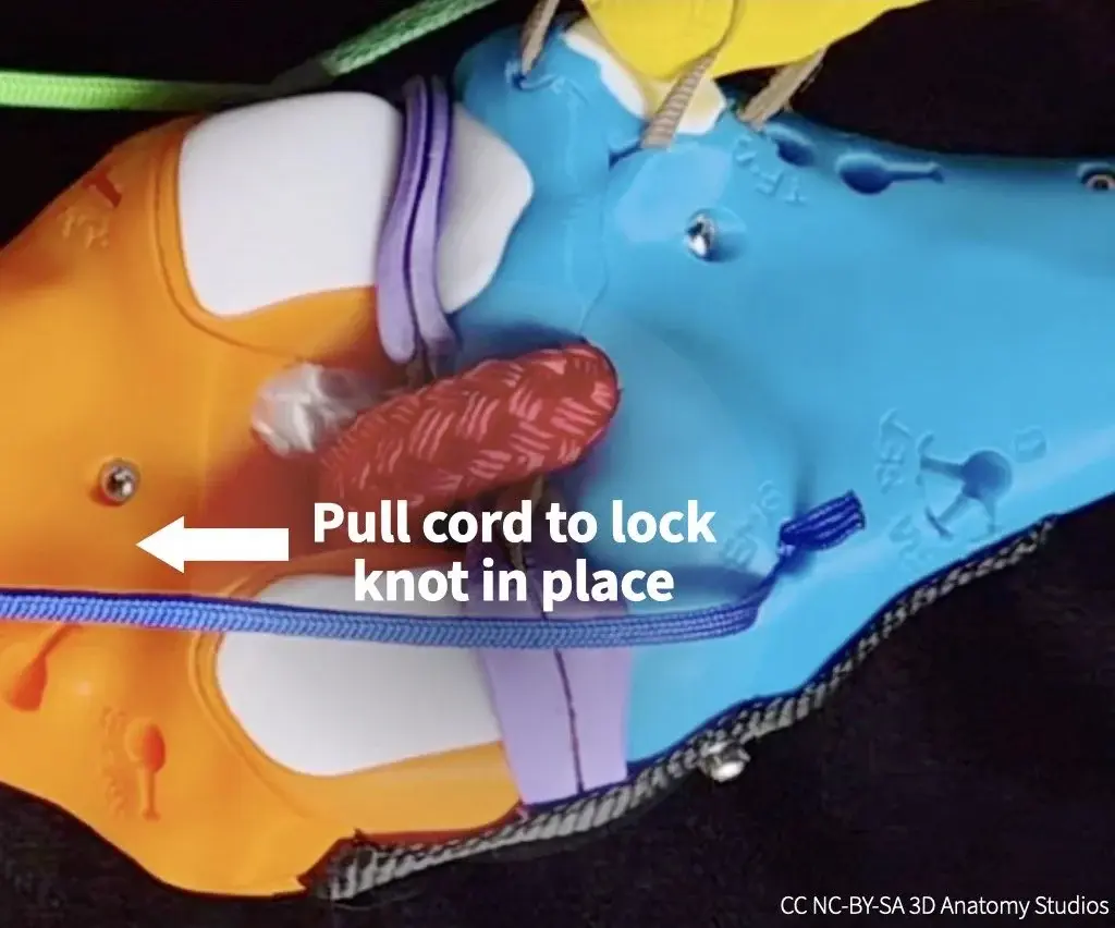 Photo of a manual muscle cord attached to a bone with an arrow and text indicating the direction to pull the cord to lock the knot into the attachment