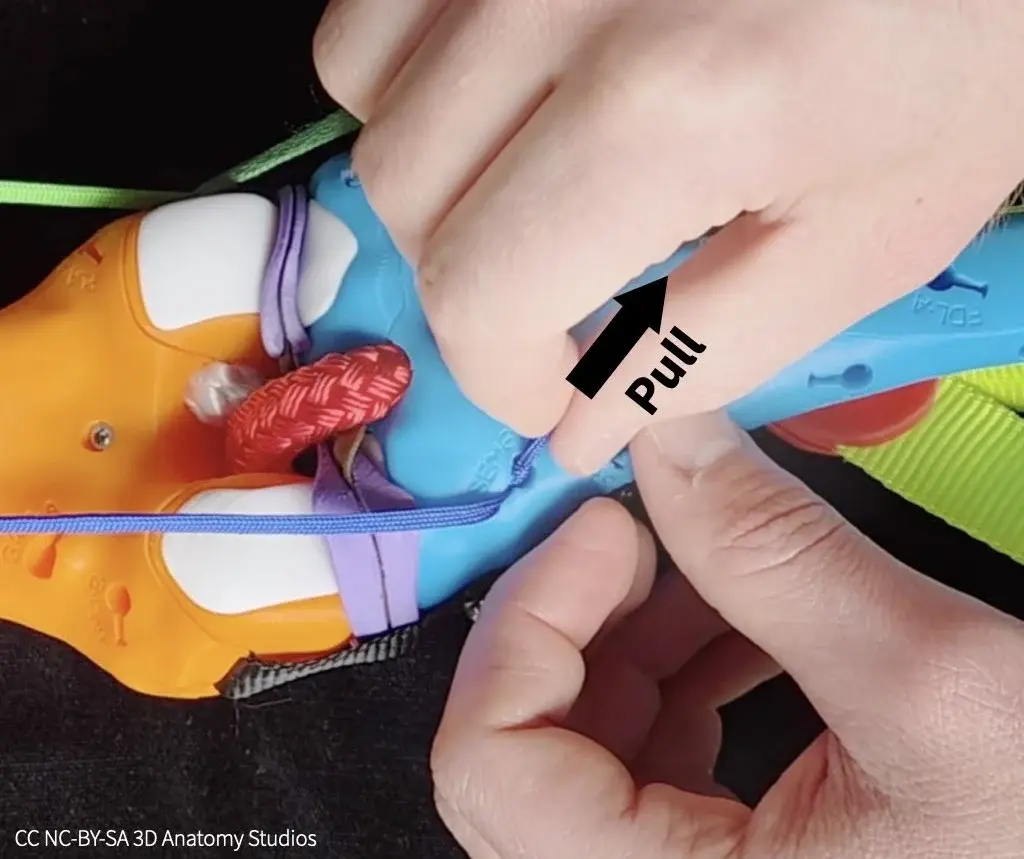 Photo of hands pulling the tail of a manual muscle cord from an attachment hole on a bone to detach the cord